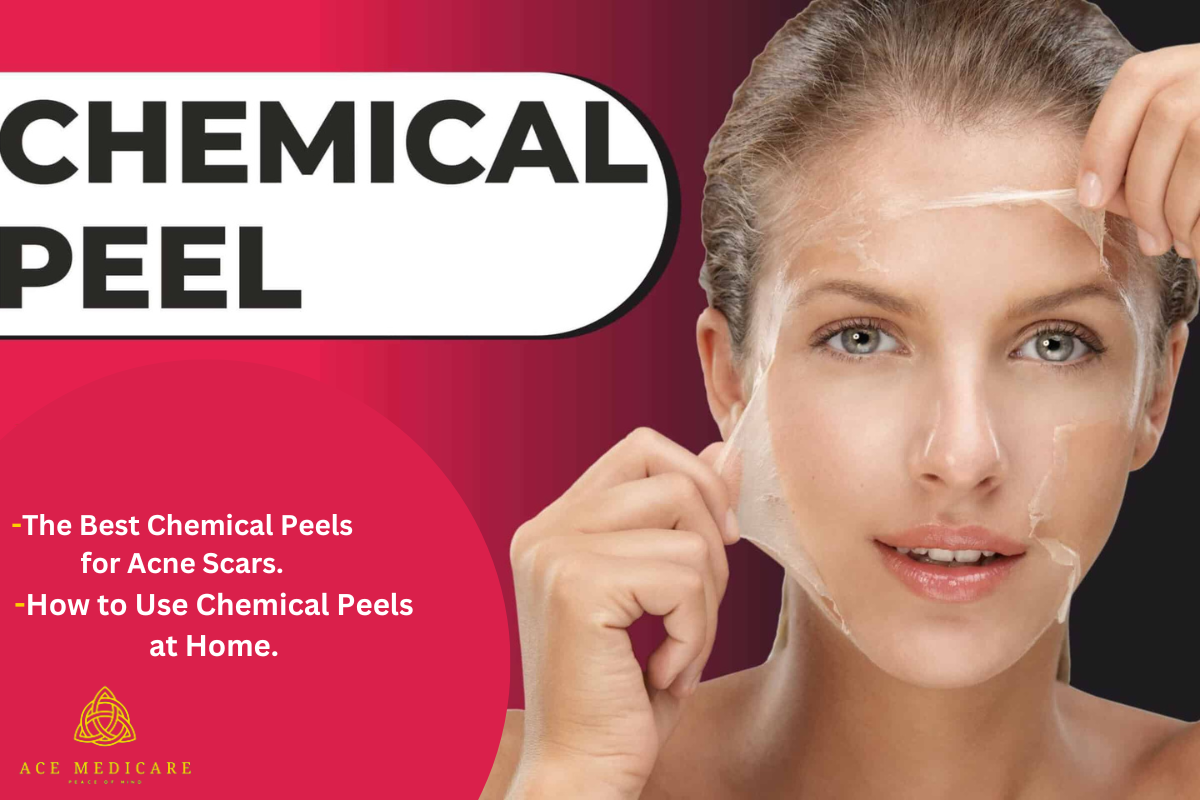 The Best Chemical Peels for Acne Scars at Home: A Comprehensive Guide